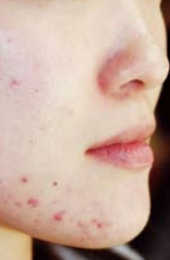 ディフェリンゲル治療前