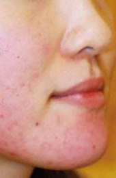 ディフェリンゲル治療開始1ヶ月後