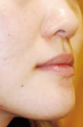 ディフェリンゲル治療2ヶ月後