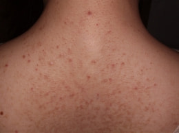 スピロノラクトン治療前