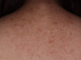 スピロノラクトン治療2ヶ月目