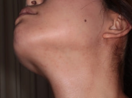 スピロノラクトン治療4ヶ月目