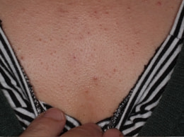 スピロノラクトン治療前