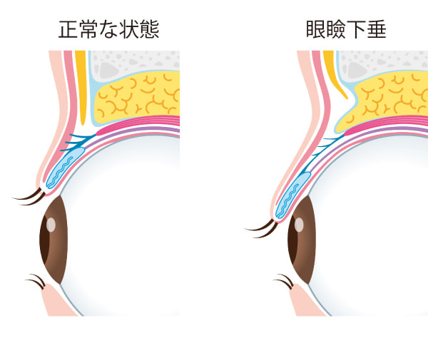 正常な状態と眼瞼下垂の違い