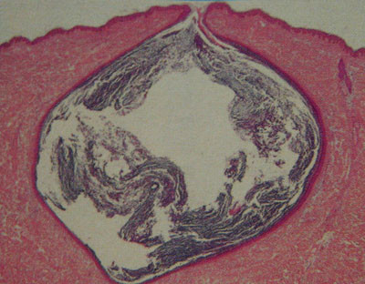 粉瘤の内部