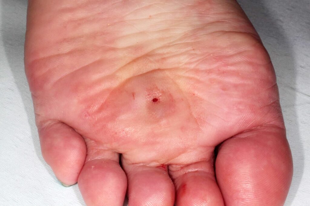 足の裏の粉瘤