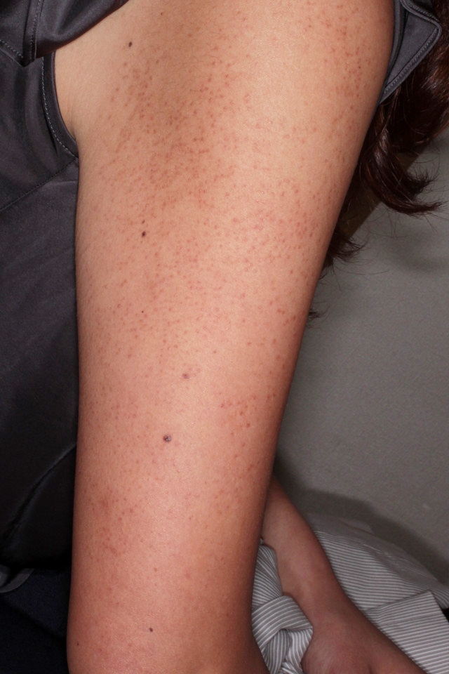 毛孔性苔癬（二の腕のぶつぶつ）のダーマローラー治療前