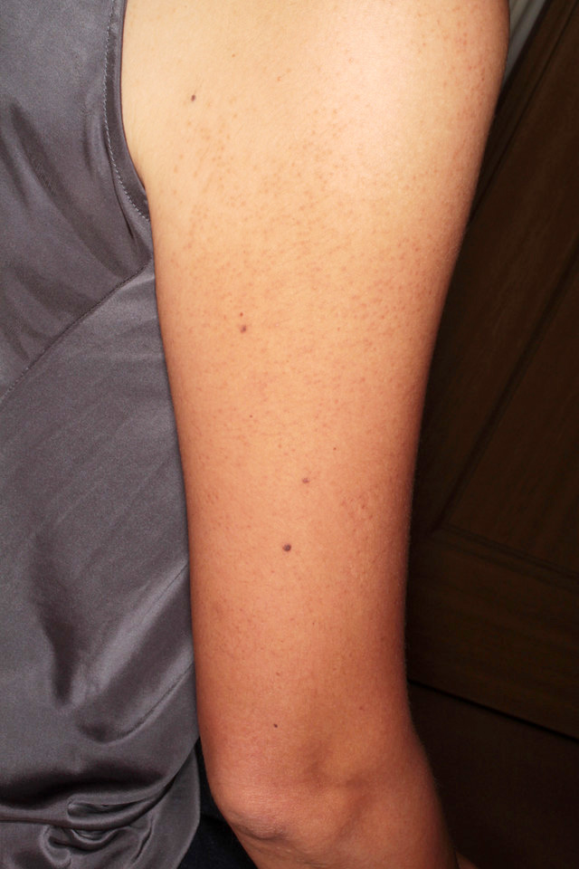 毛孔性苔癬（二の腕のぶつぶつ）のダーマローラー治療後