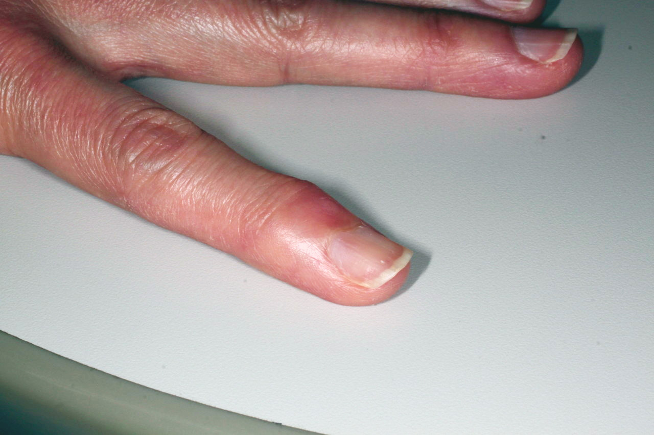指趾の粘液嚢腫の治療後