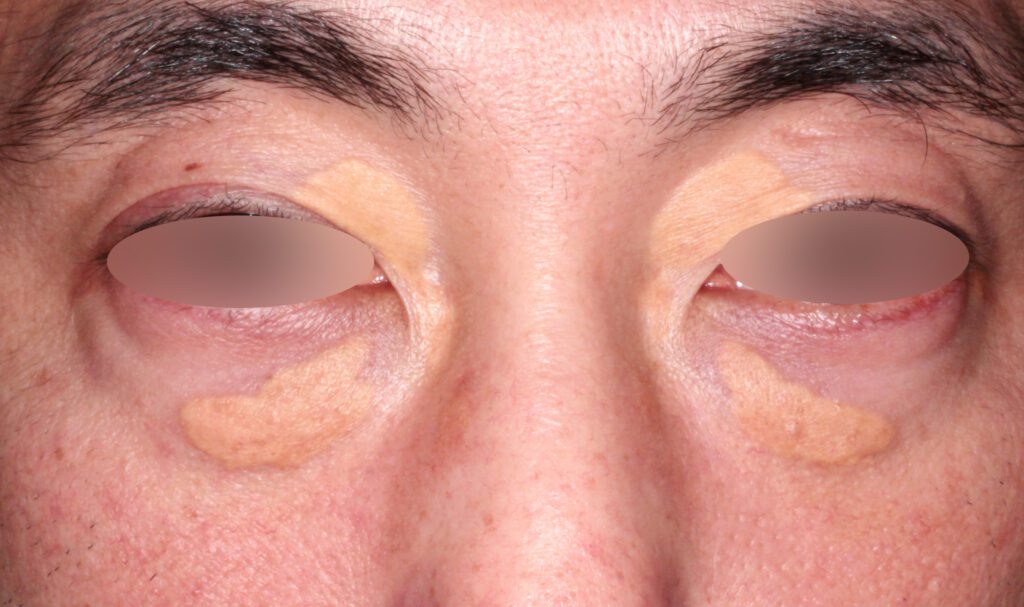 発疹性黄色腫症の治療