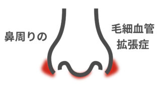 鼻周りの毛細血管拡張症